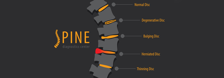 Chiropractic Sioux Falls SD Disc Issues